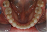 Braces