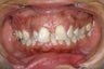 Braces