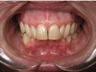 Adult Overbite, Nonextraction (braces)