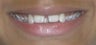Braces to correct spacing, overbite