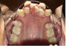 Braces
