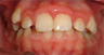Braces