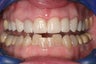 Short Term Orthodontics aka "6 Month Smiles"