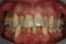 Braces