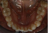 Braces
