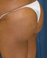 Brazilian Butt Lift 