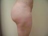 Brazilian Buttock Lift