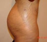 Brazilian Buttock Lift
