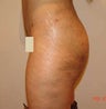 Brazilian Buttock Lift