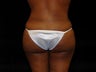 Brazilian Buttocks Lift