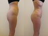Brazilian butt lift