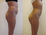 Brazilian butt lift