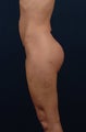Brazilian Buttock Lift