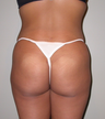 Brazilian butt lift