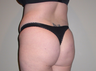 Brazilian butt lift