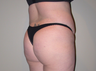 Brazilian Butt Lift