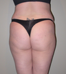 Brazilian Butt Lift