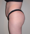 Brazilian Butt Lift