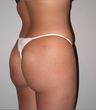 Brazilian Butt Lift