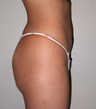 Brazilian Butt Lift