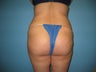 buttock augmentation (Brazilian buttock lift)