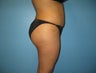 Beverly Hills Brazilian Buttock Lift