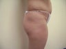 Brazilian Buttock Lift