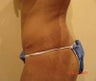 Brazilian Buttock Lift