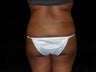Brazilian Buttocks Lift