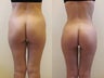 Brazilian butt lift