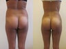 Brazilian butt lift