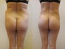 Brazilian butt lift