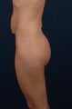 Brazilian Buttock Lift