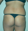 Brazilian butt lift