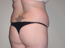 Brazilian Butt Lift