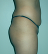 Brazilian Butt Lift