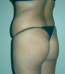 Brazilian Butt Lift