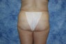 Brazilian Butt Lift