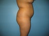 Beverly Hills Brazilian Buttock Lift