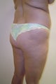 Liposculpture and Brazilian Buttock Lift