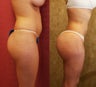 buttock augmentation