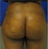 Brazilian Buttock Lift