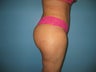 buttock augmentation (Brazilian buttock lift)