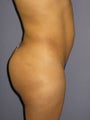 Fat Transfer, Brazilian Butt Lift