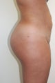 Brazilian Butt Lift