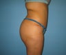 buttock augmentation (Brazilian buttock lift)