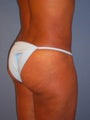Brazilian Butt Lift