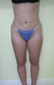 Brazilian butt lift