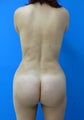 Brazilian Butt Lift