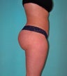 Brazilian Butt Lift